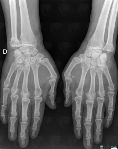 Sarcoidosis, Ulna - Distal part, X rays