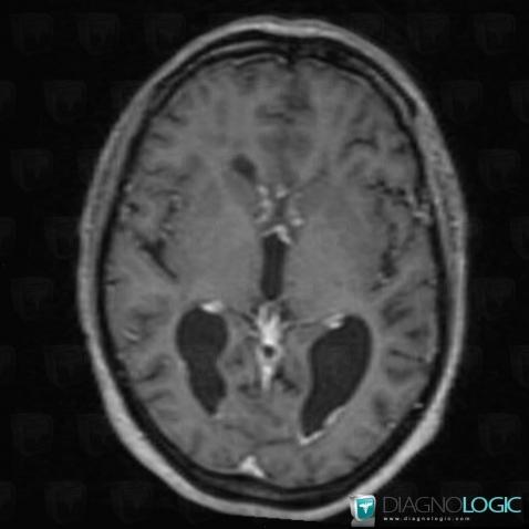 Sarcoidosis, Ventricles / Periventricular region, MRI