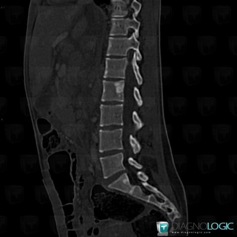 Sarcoidosis, Vertebral body / Disk, CT