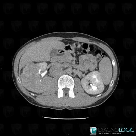 Sarcomatoid cell type renal cell carcinoma, Collecting system, CT