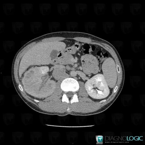 Sarcomatoid cell type renal cell carcinoma, Kidney, CT