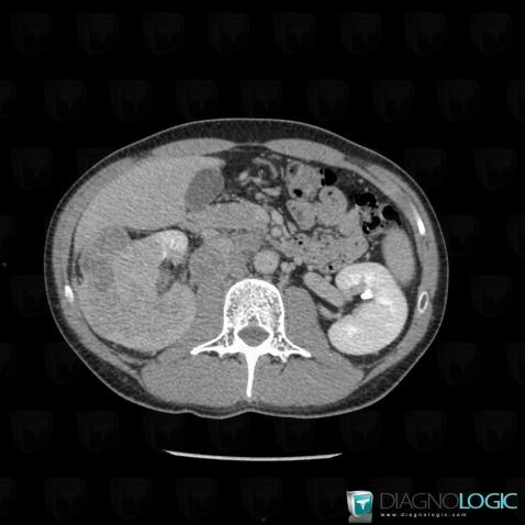 Sarcomatoid cell type renal cell carcinoma, Kidney, CT