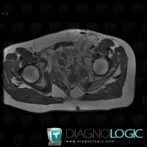 Sarcome d'Ewing, Pelvis / Périnée, IRM