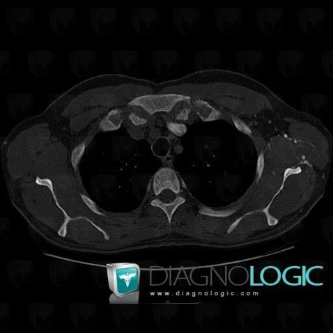 Scapula, CT