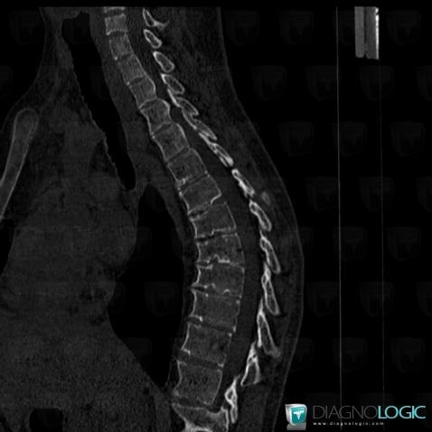 Scheuermann’s disease, Vertebral body / Disk, CT