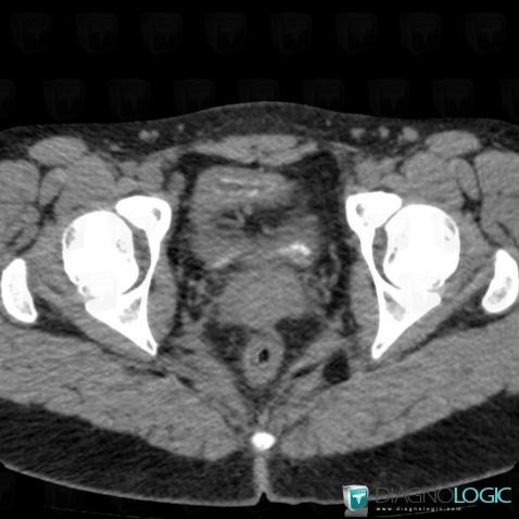 Schistosomiasis, Ureter, CT