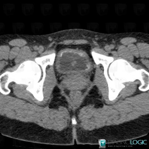 Schistosomiasis, Urinary bladder, CT