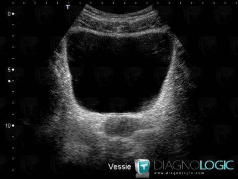 Schistosomiasis, Urinary bladder, US