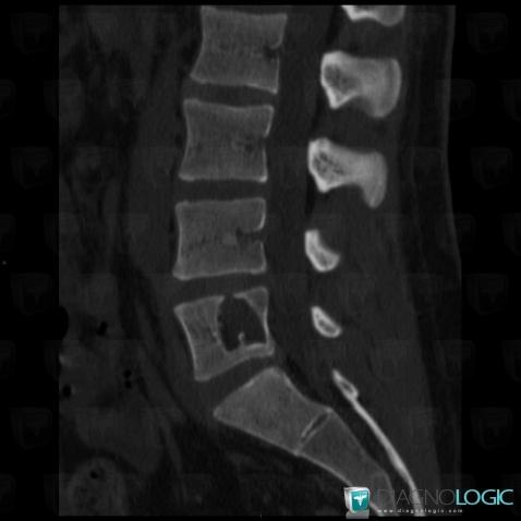 Schmorl’s nodes, Vertebral body / Disk, CT