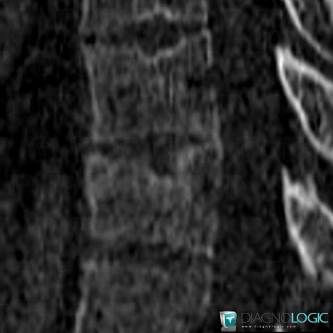 Schmorl’s nodes, Vertebral body / Disk, CT