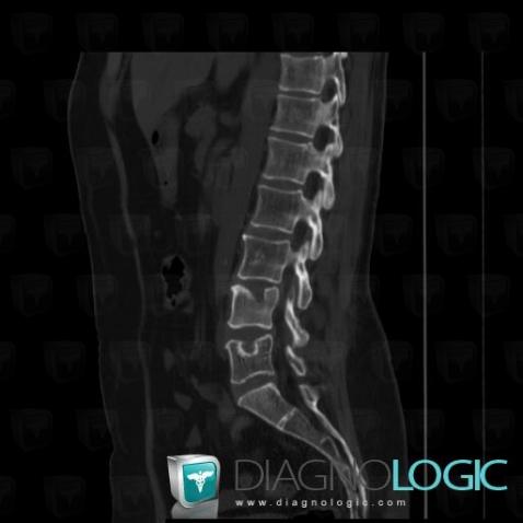 Schmorl’s nodes, Vertebral body / Disk, CT