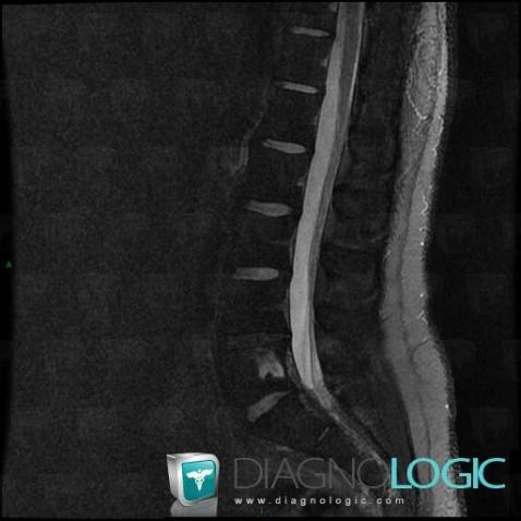 Schmorl’s nodes, Vertebral body / Disk, MRI