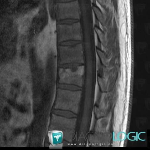 Schmorl’s nodes, Vertebral body / Disk, MRI