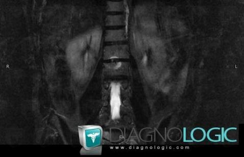 Schmorl’s nodes, Vertebral body / Disk, MRI