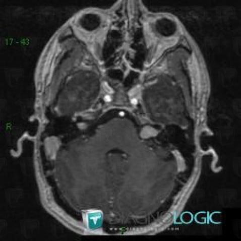 Schwannoma, Cerebellopontine angle, Infratentorial peri cerebral spaces, MRI