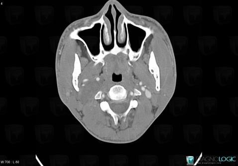 Schwannoma, Deep facial spaces, CT