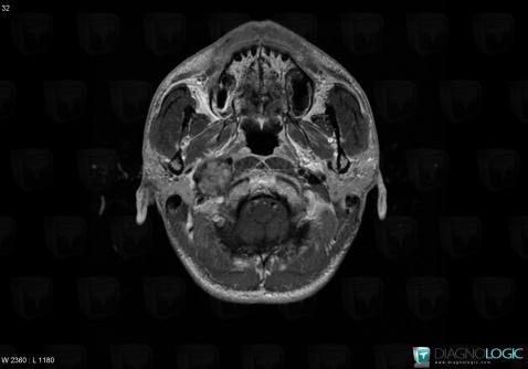 Schwannoma, Deep facial spaces, MRI