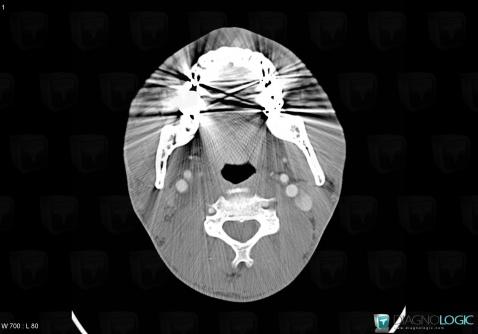 Schwannoma, Deep neck spaces, CT