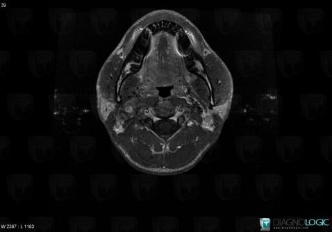 Schwannoma, Deep neck spaces, MRI