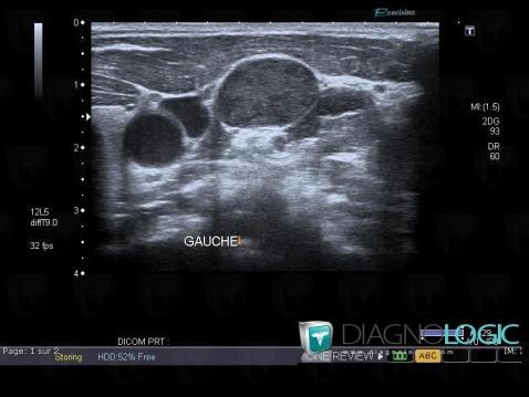 Schwannoma, Deep neck spaces, US