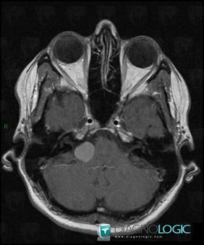 Schwannoma, Infratentorial peri cerebral spaces, Other cranial nerve, MRI