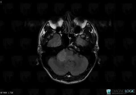 Schwannoma, Infratentorial peri cerebral spaces, Other cranial nerve, MRI