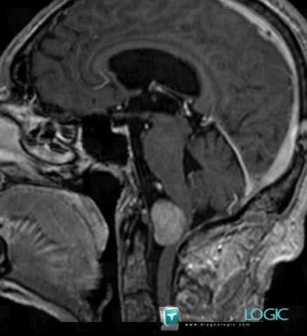 Schwannoma, Infratentorial peri cerebral spaces, Posterior fossa, MRI