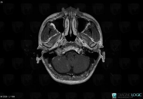 Schwannoma, Jugular foramen, MRI