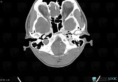 Schwannoma, Jugular foramen, Other cranial nerve, CT