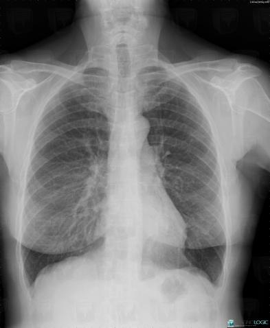 Radiology Case : Schwannoma (mri ,x Rays ,ct) - Diagnologic