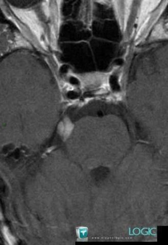 Schwannoma, Other cranial nerve, Posterior fossa, MRI