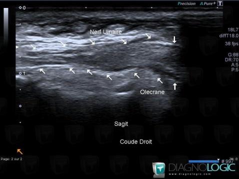 Schwannoma, Other soft tissues/nerves - Elbow, US