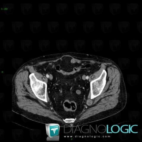 Schwannoma, Other soft tissues/nerves - Pelvis, CT