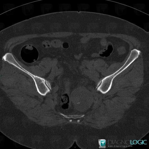 Schwannoma, Paraspinal, CT