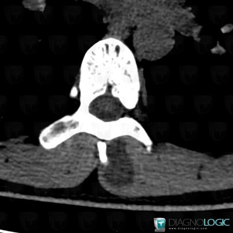 Schwannoma, Paraspinal, CT