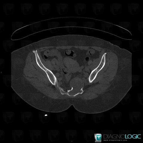 Schwannoma, Pelvis / Perineum, Sacrum / Coccyx, CT