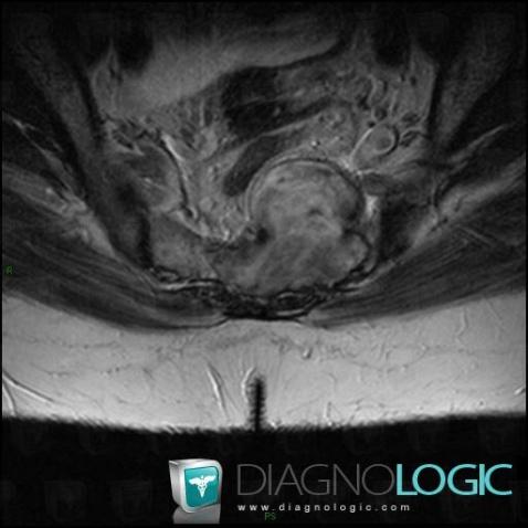 Schwannoma, Pelvis / Perineum, Sacrum / Coccyx, MRI