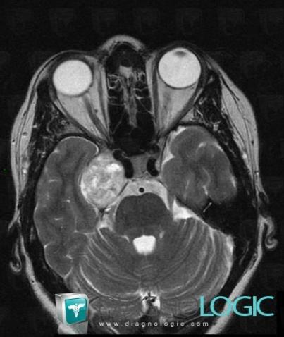 Schwannoma, Pituitary gland and parasellar region, MRI