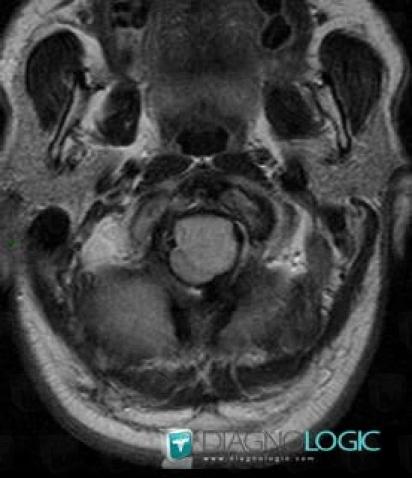 Schwannoma, Posterior fossa, MRI