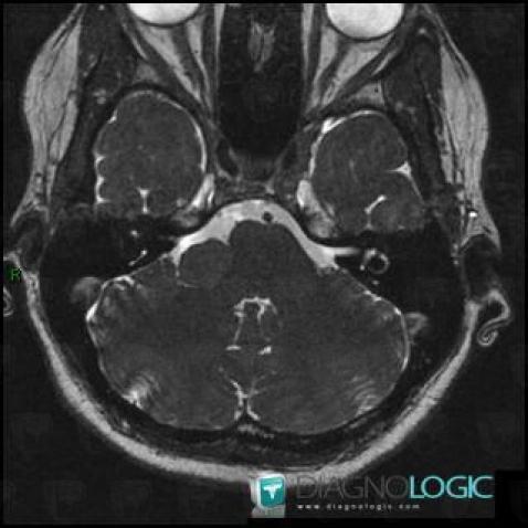 Schwannoma, Posterior fossa, MRI