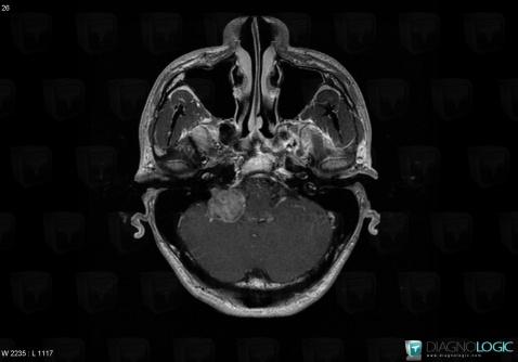 Schwannoma, Posterior fossa, MRI