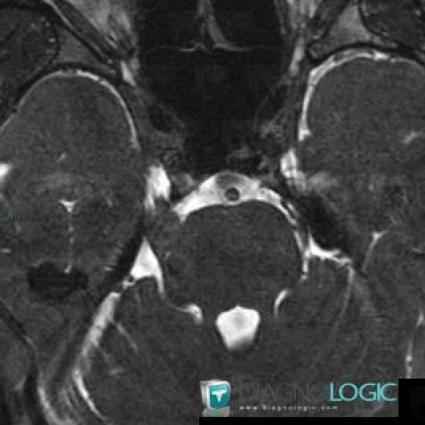 Schwannoma, Posterior fossa, MRI