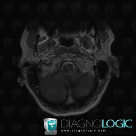 Schwannoma, Posterior fossa, MRI