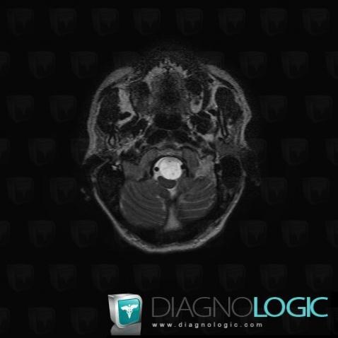 Schwannoma, Posterior fossa, MRI