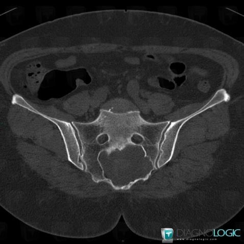 Schwannoma, Sacrum / Coccyx, CT