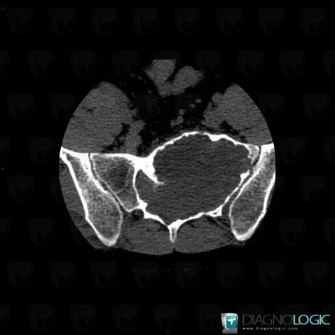 Schwannoma, Sacrum / Coccyx, CT