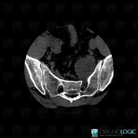 Schwannoma, Sacrum / Coccyx, CT