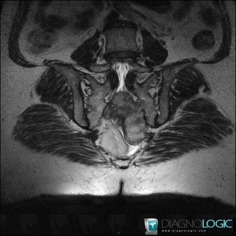 Schwannoma, Sacrum / Coccyx, MRI