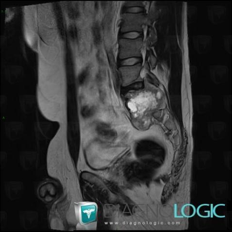 Schwannoma, Sacrum / Coccyx, MRI