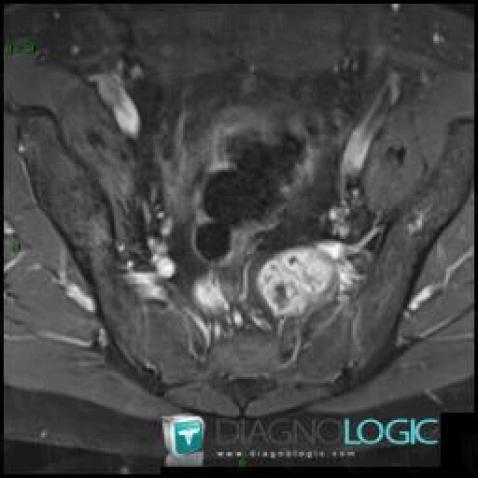 Schwannoma, Sacrum / Coccyx, MRI